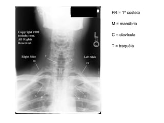 FR = 1ª costela M = manúbrio C = clavícula T = traquéia 