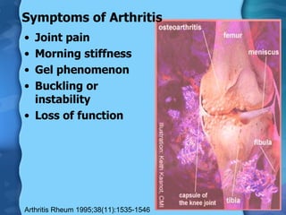 Symptoms of Arthritis Joint pain Morning stiffness Gel phenomenon Buckling or  instability Loss of function Arthritis Rheum 1995;38(11):1535-1546 