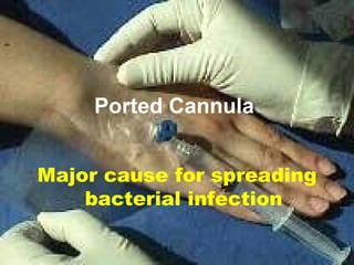 Ported Cannula Major cause for spreading bacterial infection 