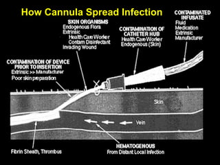 How Cannula Spread Infection 