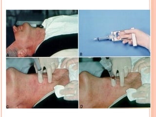 Transcricothyroid Injection Carcinoma Of Thyroid Gland | PPT