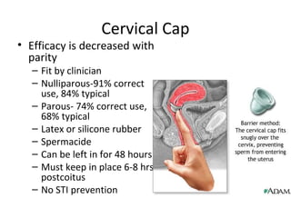 Cervical Cap
• Efficacy is decreased with
parity
– Fit by clinician
– Nulliparous-91% correct
use, 84% typical
– Parous- 74% correct use,
68% typical
– Latex or silicone rubber
– Spermacide
– Can be left in for 48 hours
– Must keep in place 6-8 hrs
postcoitus
– No STI prevention
 