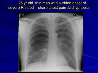 Early Management Of Of Mi | PPT