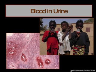 Blood in Urine www1.imperial.ac.uk/.../schisto_children.jpg 