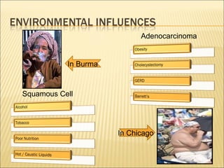 Squamous Cell Adenocarcinoma In Burma In Chicago 
