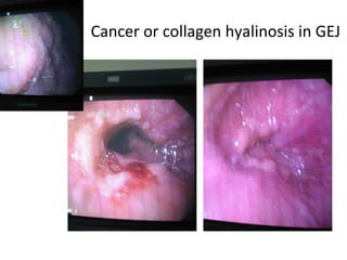 Cancer or collagen hyalinosis in GEJ 