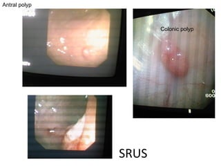 SRUS Antral polyp Colonic polyp 