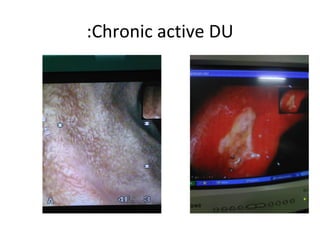 Chronic active DU: 