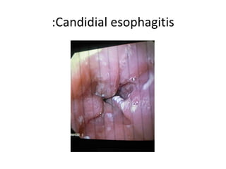 Candidial esophagitis: 