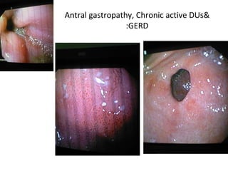 Antral gastropathy, Chronic active DUs& GERD: 