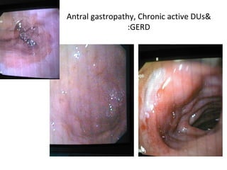 Antral gastropathy, Chronic active DUs& GERD: 