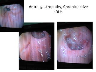 Antral gastropathy, Chronic active DUs: 