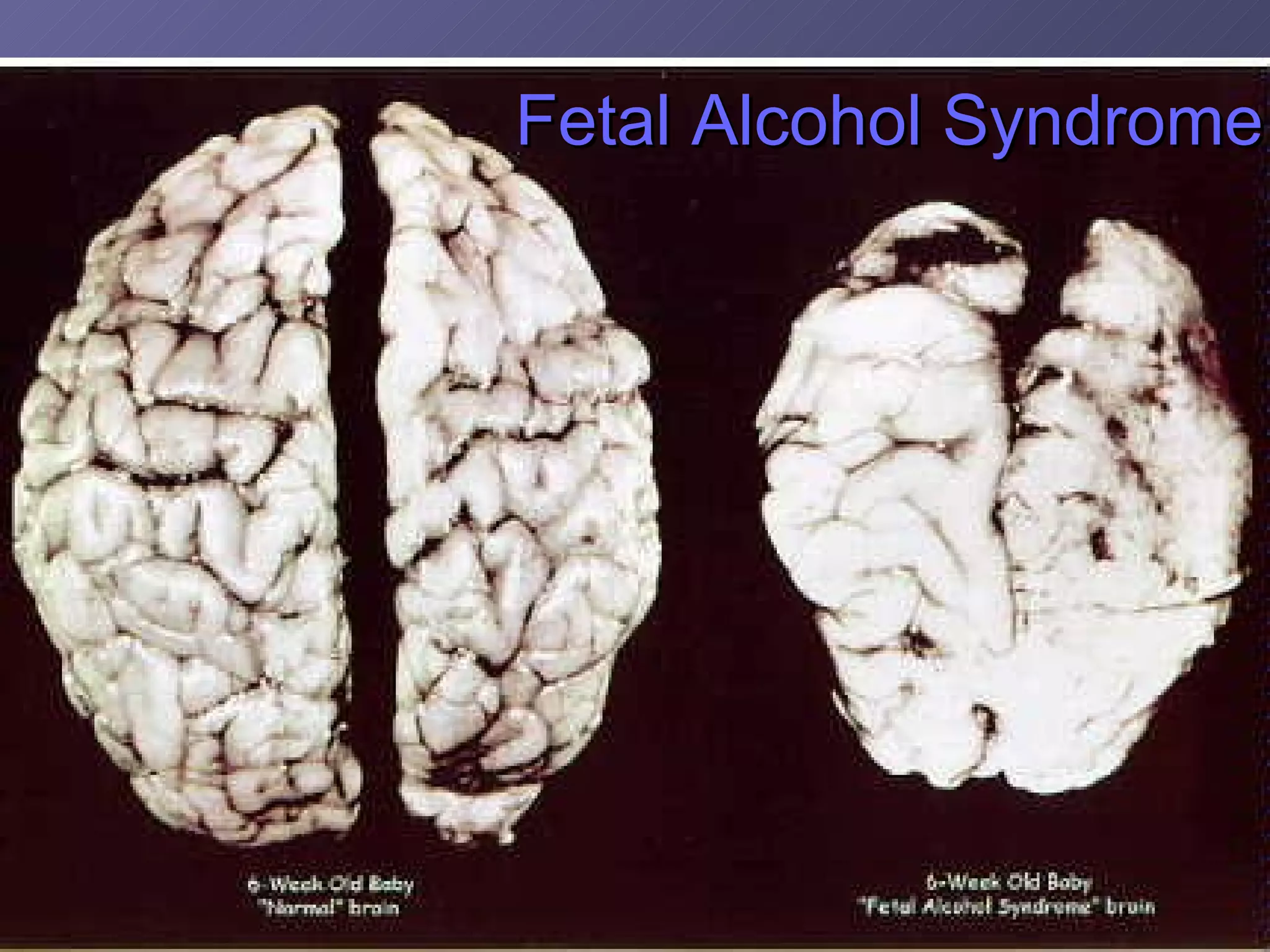 Fetal Alcohol Syndrome 