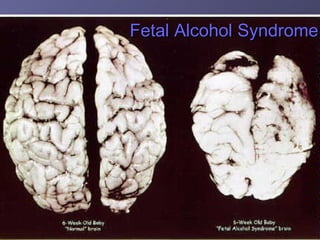 Fetal Alcohol Syndrome 