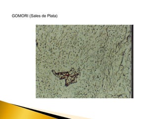 GOMORI (Sales de Plata)
 