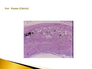 Von Kossa (Calcio)
 
