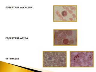 FOSFATASA ALCALINA
FOSFATASA ACIDA
ESTERASAS
 