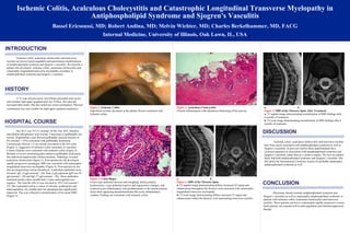 Ischemic Colitis, Acalculous Cholecystitis and Catastrophic Longitudinal Transverse Myelopathy in Antiphospholipid Syndrome and Sjogren's Vasculitis Bassel Ericsoussi, MD; Robert Andina, MD; Melvin Wichter, MD; Charles Berkelhammer, MD, FACG Internal Medicine, University of Illinois, Oak Lawn, IL, USA Ischemic colitis, acalculous cholecystitis and transverse myelitis are known hypercoagulable and autoimmune manifestations of antiphospholipid syndrome and Sjogren’s vasculitis. We describe a patient who developed  ischemic colitis, acalculous cholecystitis and catastrophic longitudinal transverse myelopathy secondary to antiphospholipid syndrome and Sjogren’s vasculitis.  HOSPITAL COURSE INTRODUCTION Her ALT was 74 U/L (normal 10-40). Her AST, bilirubin and alkaline phosphatase were normal. Ultrasound of gallbladder was normal. Hepatobiliary scan showed gallbladder ejection fraction of 4% (normal < 35%) consistent with gallbladder dyskinesia. Colonoscopy showed 1-2 cm circular ulceration in the left colon (Figure 1), suggestive of ischemic colitis secondary to vasculitis. Colonic biopsies were consistent with ischemic colitis (Figure 2). Because of severe unrelenting pain related to gallbladder dyskinesia, she underwent laparoscopic cholecystectomy. Pathology revealed acalculous cholecystitis (figure 3). Post-operatively she developed rapidly progressive paraplegia. MRI was consistent with catastrophic longitudinal transverse myelopathy (Figure 4). Post-operatively she also developed deep venous thrombosis. Cardiolipin antibodies were elevated: IgG 34 gpl (normal < 20). Beta-2-glycoprotein IgM was 95 gpl (normal < 20) and IgG 57 gpl (normal < 20). These antibodies remained positive three months later. Lupus anticoagulant was negative. The Anti-Ro (SS-A) was elevated at 129 U/ml (normal < 25). She responded well to a course of steroids, azathioprine and anticoagulation. Six months later her paraplegia has significantly improved. This was reflected in normalization of her spinal MRI (Figure 5). A 52 year old previously well female presented with severe and constant right upper quadrant pain for 10 days. Her pain did increased after meals. She also noted new onset constipation. Physical examination was only notable for right upper quadrant tenderness .  a.  b.  Figure 4.  MRI of the Thoracic Spine  a.  T2 sagittal image demonstrating diffuse increased T2 signal and enhancement throughout the thoracic cord consistent with catastrophic longitudinal transverse myelopathy.  b.  T2 axial image demonstrating diffuse increased T2 signal and enhancement within the thoracic cord representing transverse myelitis. DISCUSSION Ischemic colitis, acalculous cholecystitis and transverse myelitis have been rarely associated with antiphospholipid syndrome as well as Sjogren’s vasculitis. In previous reports these manifestations have occurred separately in association with antiphospholipid syndrome and Sjogren’s vasculitis, rather than as a cluster complex. We feel our patient likely had both antiphospholipid syndrome and Sjogren’s vasculitis. She did satisfy the International Consensus criteria for probable catastrophic antiphospholipid syndrome as well. CONCLUSION Physicians should consider antiphospholipid syndrome and Sjogren’s vasculitis as well as catastrophic antiphospholipid syndrome in patients with ischemic colitis, acalculous cholecystitis and transverse myelitis. These patients can have a catastrophic rapidly progressive course. Such patients can respond well to anticoagulation and immunosuppressive therapy. HISTORY a.  b.  Figure 4.  MRI of the Thoracic Spine After Treatment a.  T2 sagittal image demonstrating normalization of MRI findings after 6 months of treatment. b.  T2 axial image demonstrating normalization of MRI findings after 6 months of treatment. Figure 1.  Ischemic Colitis Superficial circular ulceration at the splenic flexure consistent with ischemic colitis. Figure 2.  Colon Biopsy Focal crypt epithelial necrosis and sloughing, lamina propria hyalinization, crypt epithelial reactive and regenerative changes, and scattered acute inflammatory cells predominantly in the lamina propria. Some thick appearing pseudomembrane-like acute inflammatory exudate. Findings are consistent with ischemic colitis. Figure 3 .  Acalculous Cholecystitis Chronic inflammation with edematous thickening of the mucosa. 