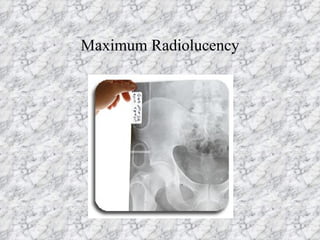 Maximum Radiolucency 