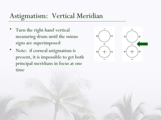 Astigmatism:  Vertical Meridian Turn the right-hand vertical measuring drum until the minus signs are superimposed Note:  if corneal astigmatism is present, it is impossible to get both principal meridians in focus at one time 