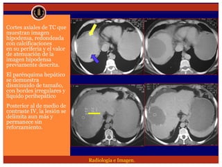 Lesion focal hepatica