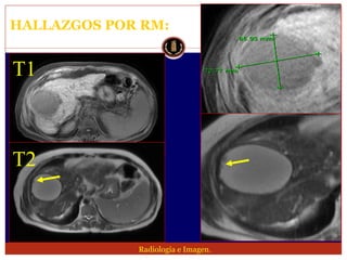 Lesion focal hepatica