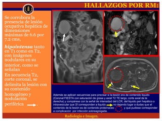 Lesion focal hepatica