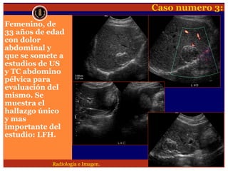 Lesion focal hepatica