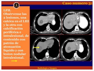 Lesion focal hepatica