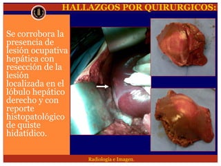 Lesion focal hepatica