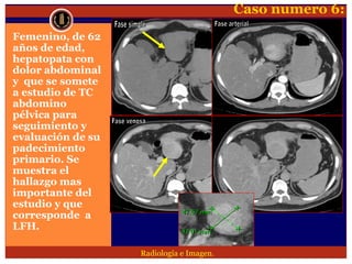 Lesion focal hepatica