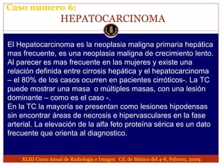 Lesion focal hepatica