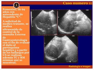 Lesion focal hepatica
