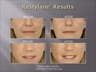 BEFORE AFTER NASOLABIAL FOLDS  Individual results may vary. BEFORE AFTER 