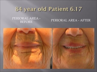 PERIORAL AREA - BEFORE PERIORAL AREA - AFTER 