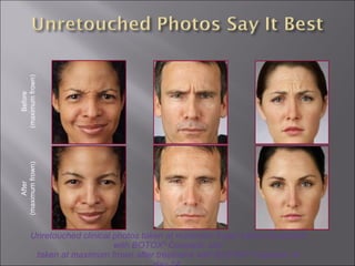 Unretouched clinical photos taken at maximum frown before treatment with BOTOX ®  Cosmetic and taken at maximum frown after treatment with BOTOX ®  Cosmetic at day 14. Before (maximum frown) After (maximum frown) 