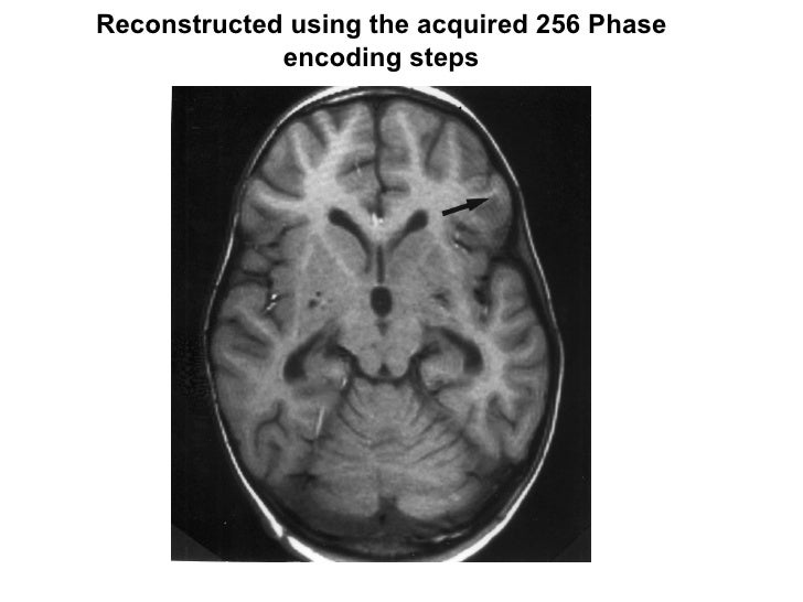 Gibbs Ringing Mri Gibbs Ringing Mri