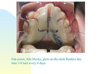 Fan screw, bite blocks, glow-in-the-dark Raiders fan,  turn 1/4 turn every 4 days. 
