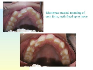 Diastemas created, rounding of arch form, teeth freed up to move 