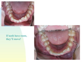 If teeth have room, they’ll move! 