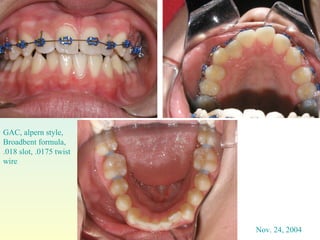Nov. 24, 2004 GAC, alpern style, Broadbent formula, .018 slot, .0175 twist  wire  