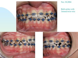 Nov 30,2004 Both arches with 3strand twist wire 