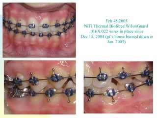 Feb 18,2005 NiTi Thermal Bioforce W/IonGuard  .016X.022 wires in place since Dec 15, 2004 (pt’s house burned down in Jan. 2005) 