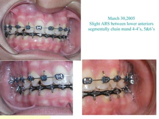 March 30,2005 Slight ARS between lower anteriors segmentally chain mand 4-4’s, 5&6’s 