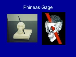 Phineas Gage 