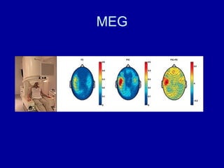 MEG 