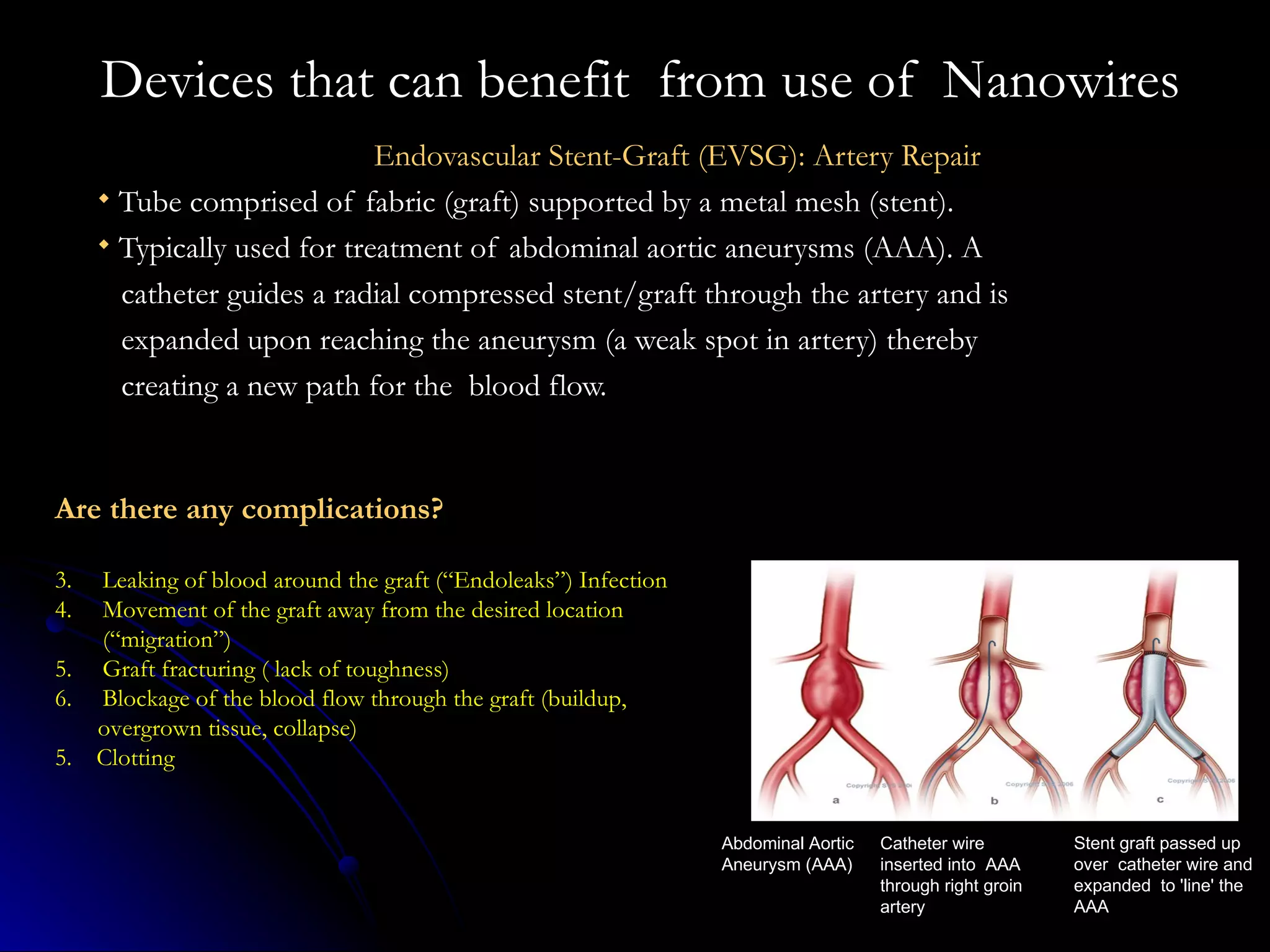 Endovascular Stent-Graft (EVSG): Artery Repair Tube comprised of fabric (graft) supported by a metal mesh (stent). Typically used for treatment of abdominal aortic aneurysms (AAA). A  catheter guides a radial compressed stent/graft through the artery and is  expanded upon reaching the aneurysm (a weak spot in artery) thereby  creating a new path for the  blood flow.  Are there any complications?   Leaking of blood around the graft (“Endoleaks”) Infection  Movement of the graft away from the desired location (“migration”)  Graft fracturing ( lack of toughness) Blockage of the blood flow through the graft (buildup,  overgrown tissue, collapse) 5.  Clotting Devices that can benefit  from use of  Nanowires Stent graft passed up over  catheter wire and expanded  to 'line' the AAA Catheter wire inserted into  AAA through right groin artery Abdominal Aortic Aneurysm (AAA) 