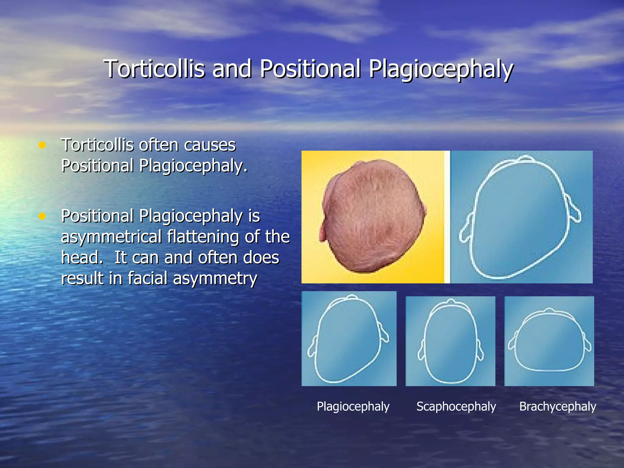 Torticollis and Positional Plagiocephaly  Torticollis often causes Positional Plagiocephaly.  Positional Plagiocephaly is asymmetrical flattening of the head.  It can and often does result in facial asymmetry  Plagiocephaly  Scaphocephaly  Brachycephaly 
