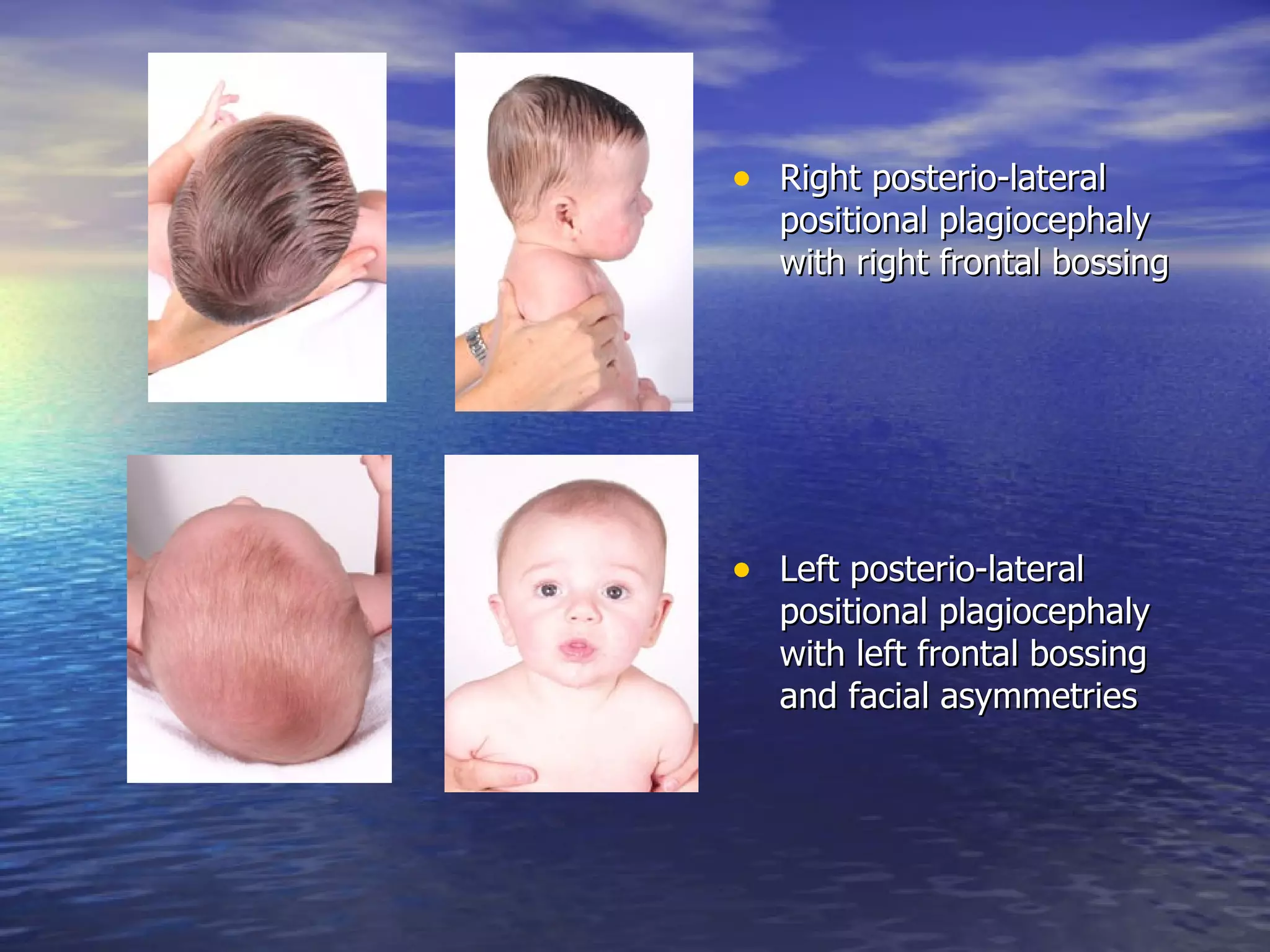 Right posterio-lateral positional plagiocephaly with right frontal bossing Left posterio-lateral positional plagiocephaly with left frontal bossing and facial asymmetries 