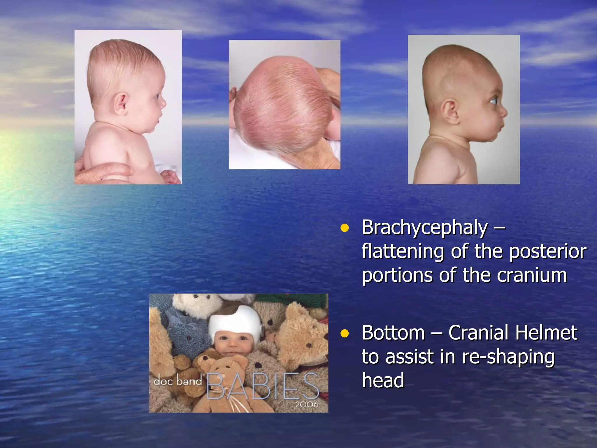 Brachycephaly – flattening of the posterior portions of the cranium Bottom – Cranial Helmet to assist in re-shaping head 